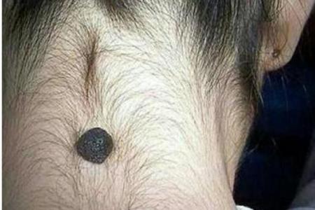 风水上女生脖子后面有痣代表什么啊