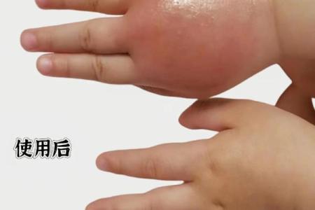 蚊子不喜欢什么血型 蚊子厌恶哪种血型