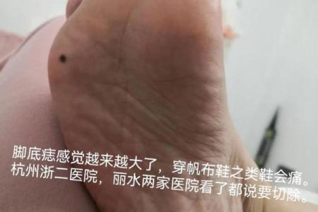 脚上胎记算命，脚底长胎记好不好