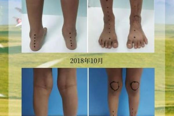 内八字脚