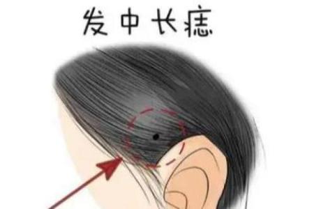 痣长在脸上哪个位置好 有福气之人财神眷顾