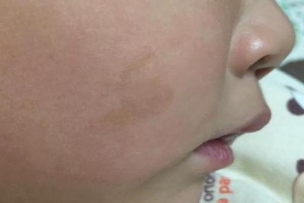 脸上各部位的胎记如何分析算命？