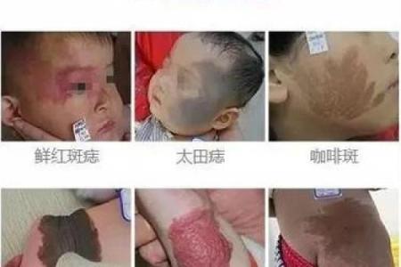 脸上各部位的胎记如何分析算命？