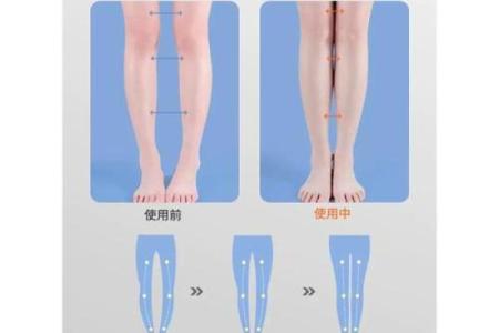 怎样纠正内八字,14岁内八字怎么矫正最快