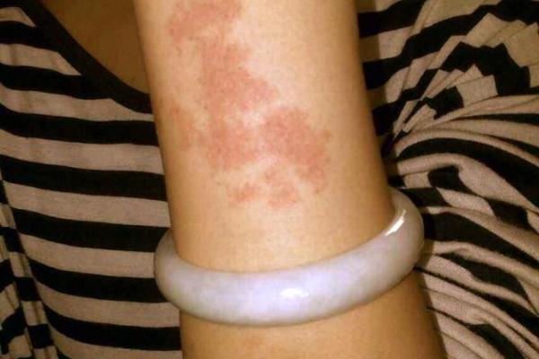 胎记算命胎记的位置与命运 胎记算命胎记的位置与命运