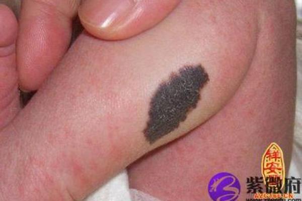 胎记算命胎记的位置与命运 胎记算命胎记的位置与命运