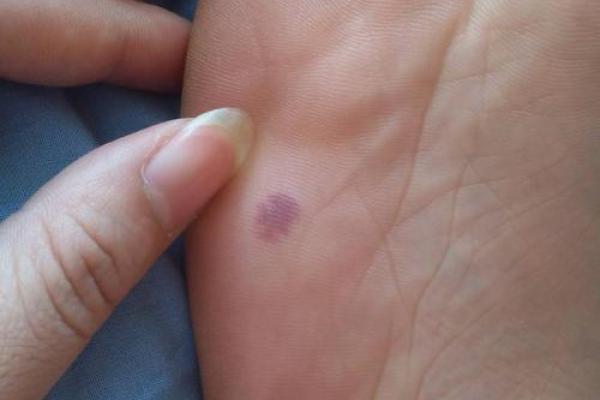 如何根据背部胎记算命-