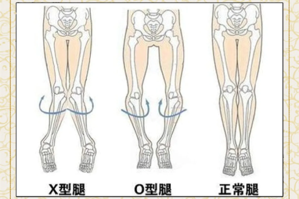 小腿内八字 小腿内八字