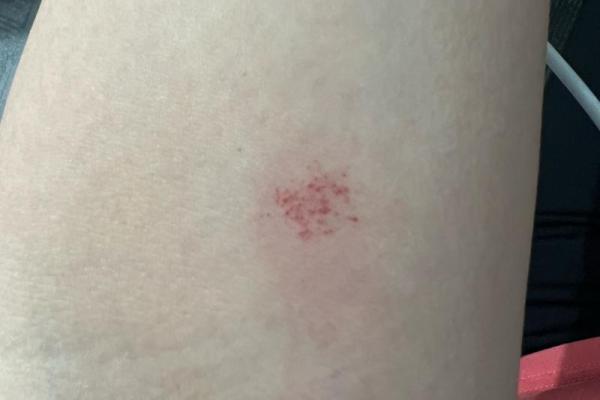 胳膊胎记算命 胳膊胎记算命