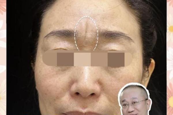 八字纹怎么去除 八字纹怎么去除