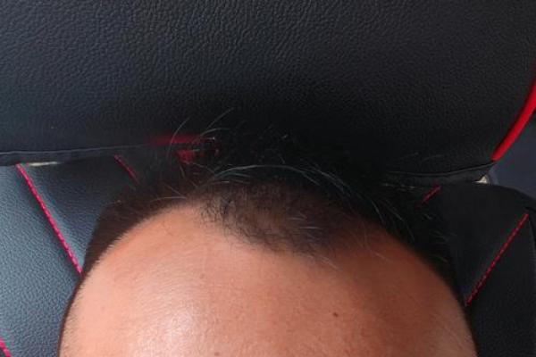 什么是倒八字眉？