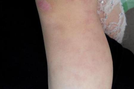 腿上不同位置的胎记算命