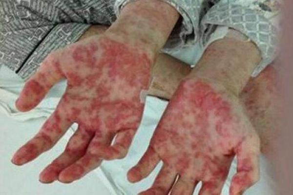 肝癌和血癌八字 肝癌和血癌八字