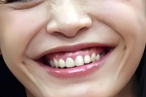 八字型门牙 八字型门牙