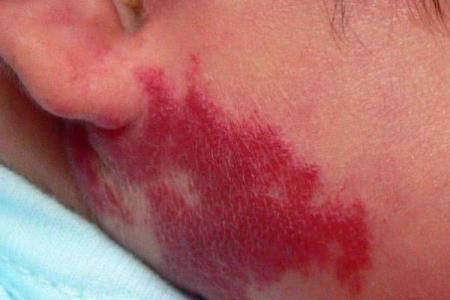 红色的胎记如何看相算命-