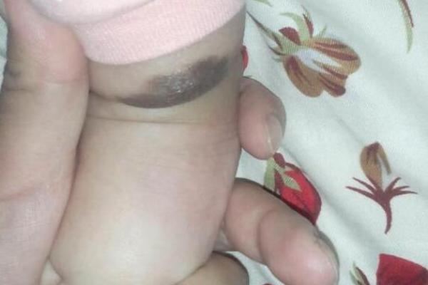 胎记释义,胎记算命中代表什么 胎记释义,胎记算命中代表什么