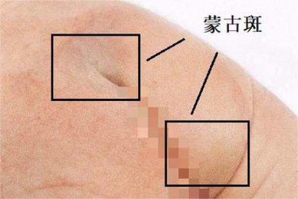 屁股有胎记算命分析 屁股有胎记算命分析