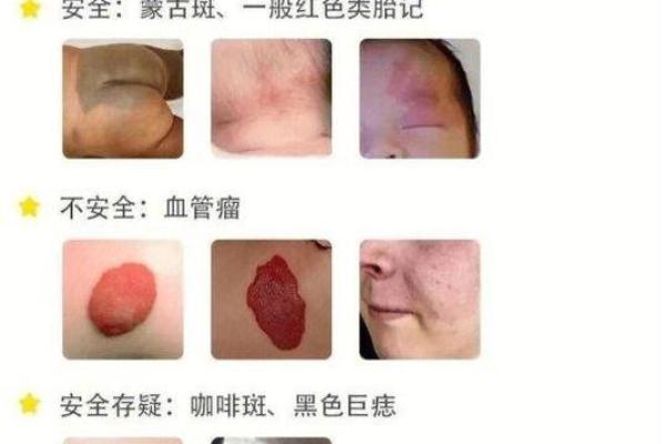 面部不同位置的胎记算命 面部不同位置的胎记算命